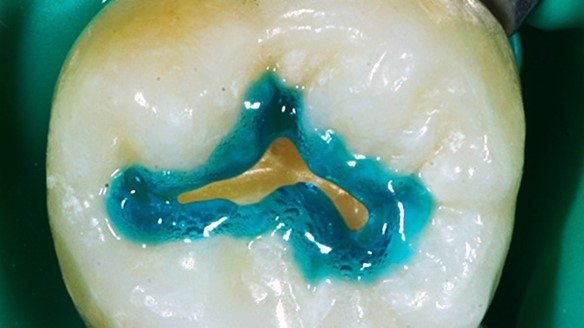 Gel revitalisant pour les dents