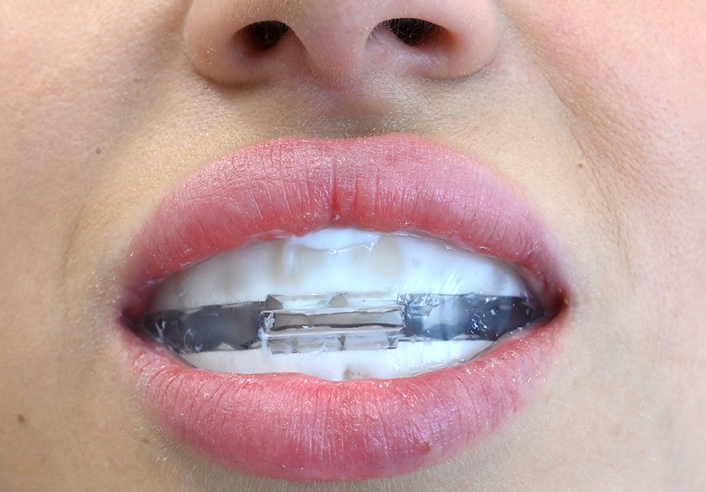 Kit de reminéralisation et de MIH (dents de craie)